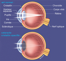 explication_cataracte1